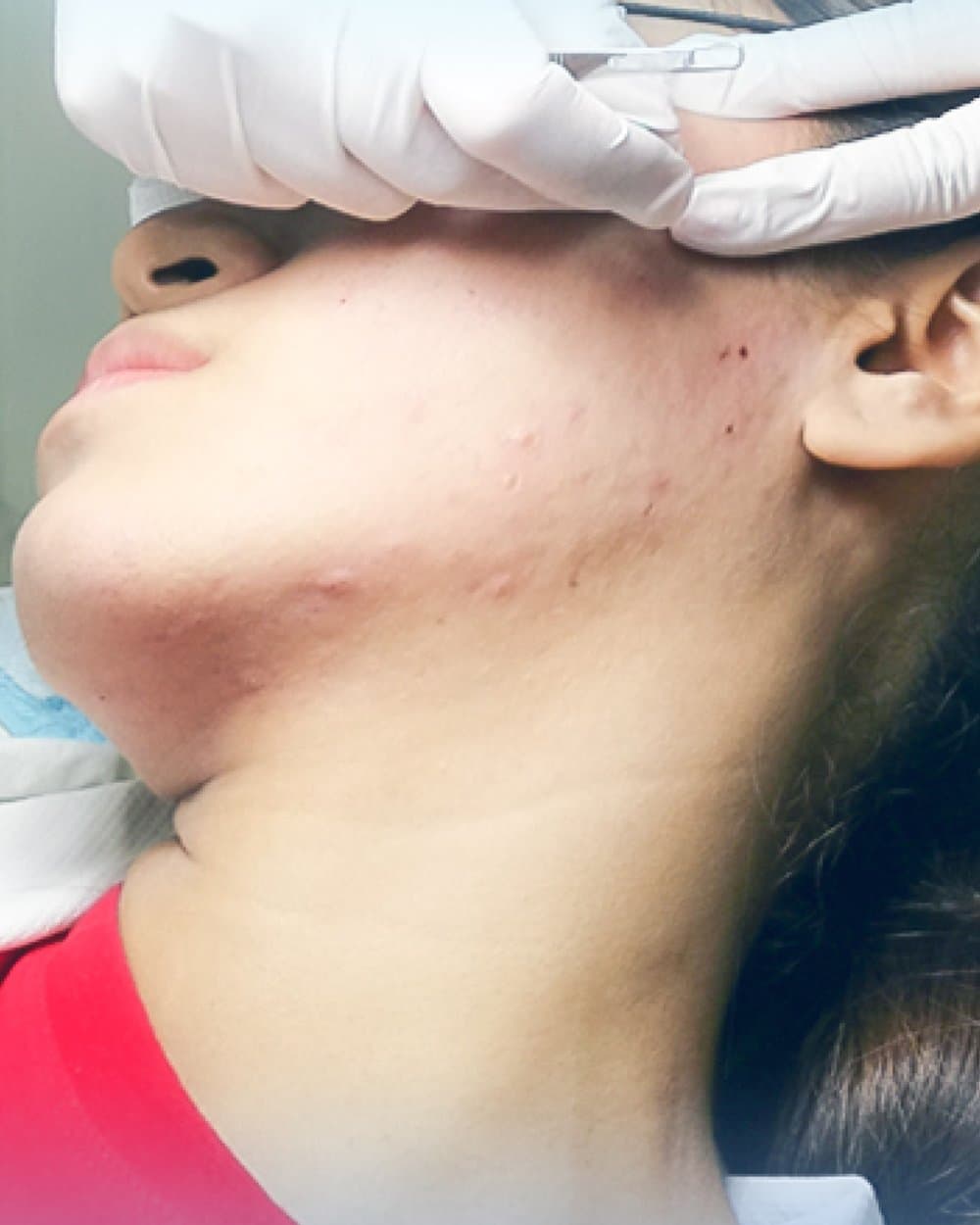 Acne Full Session
