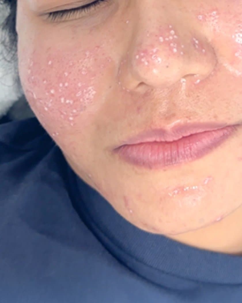 Acne Scar Program — Classic